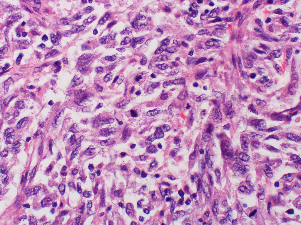 A systems methodology to assess the risk of tumor relapse in melanoma - MelEVIR